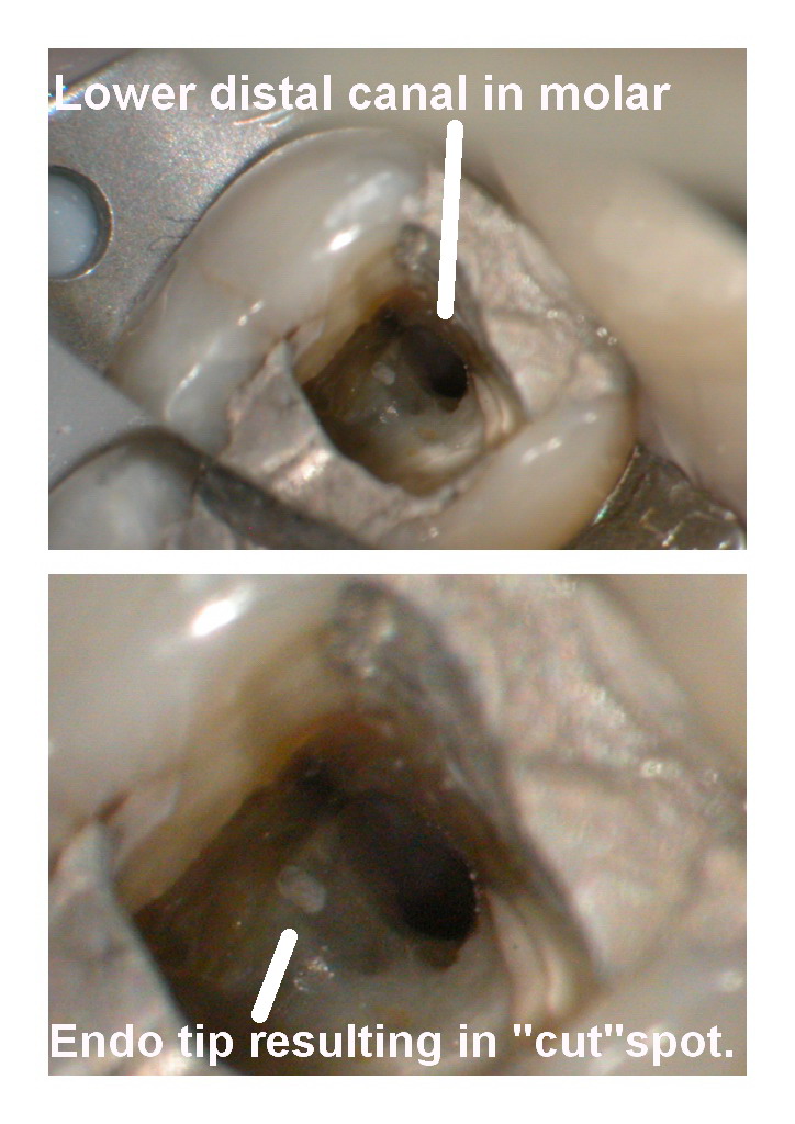 Lower molar endo spot edited.jpg